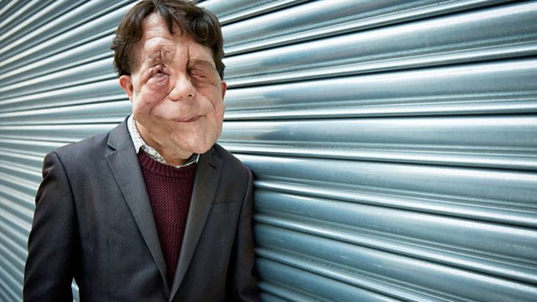 The Ugly Face of Disability Hate Crime still 1